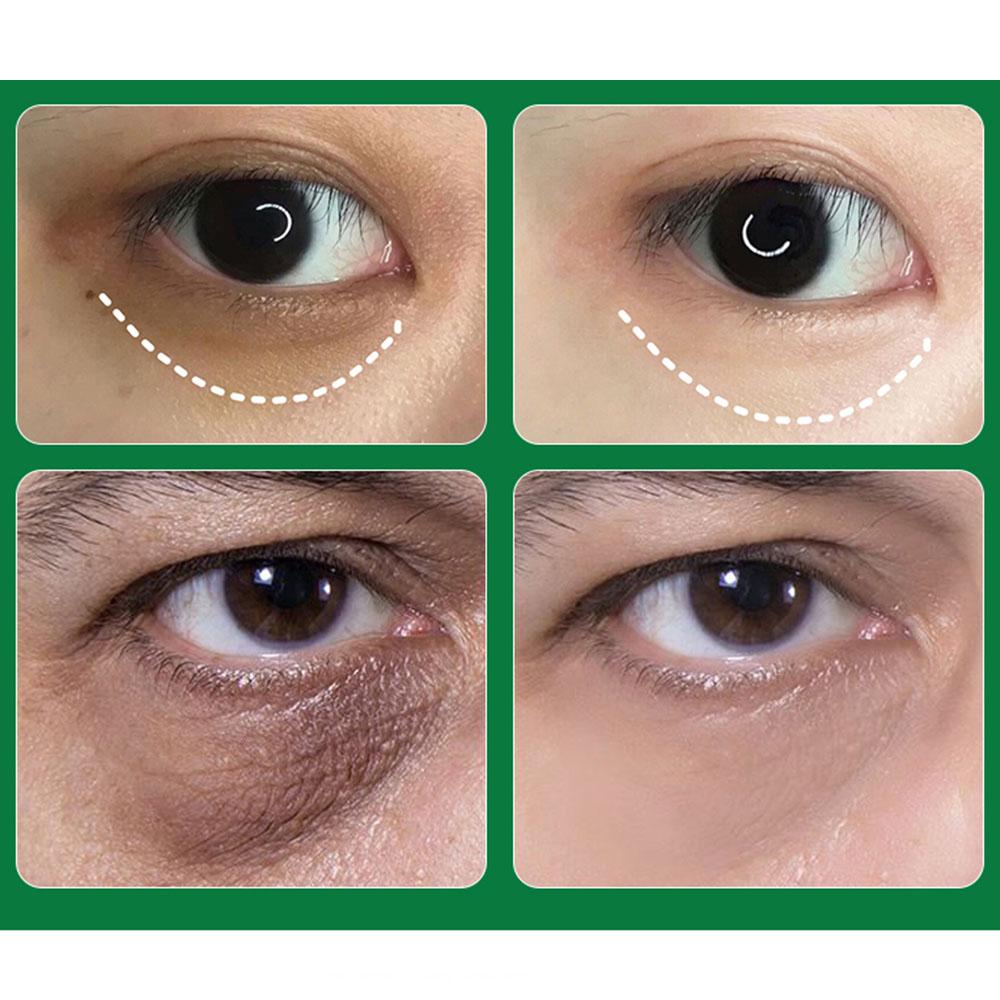 Aichun Beauty Eye Mask Reduces Wrinkles and Puffiness - 5 Pieces